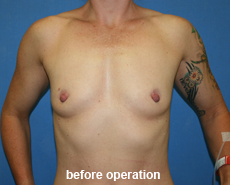 plastic-surgery-breast-augmentation